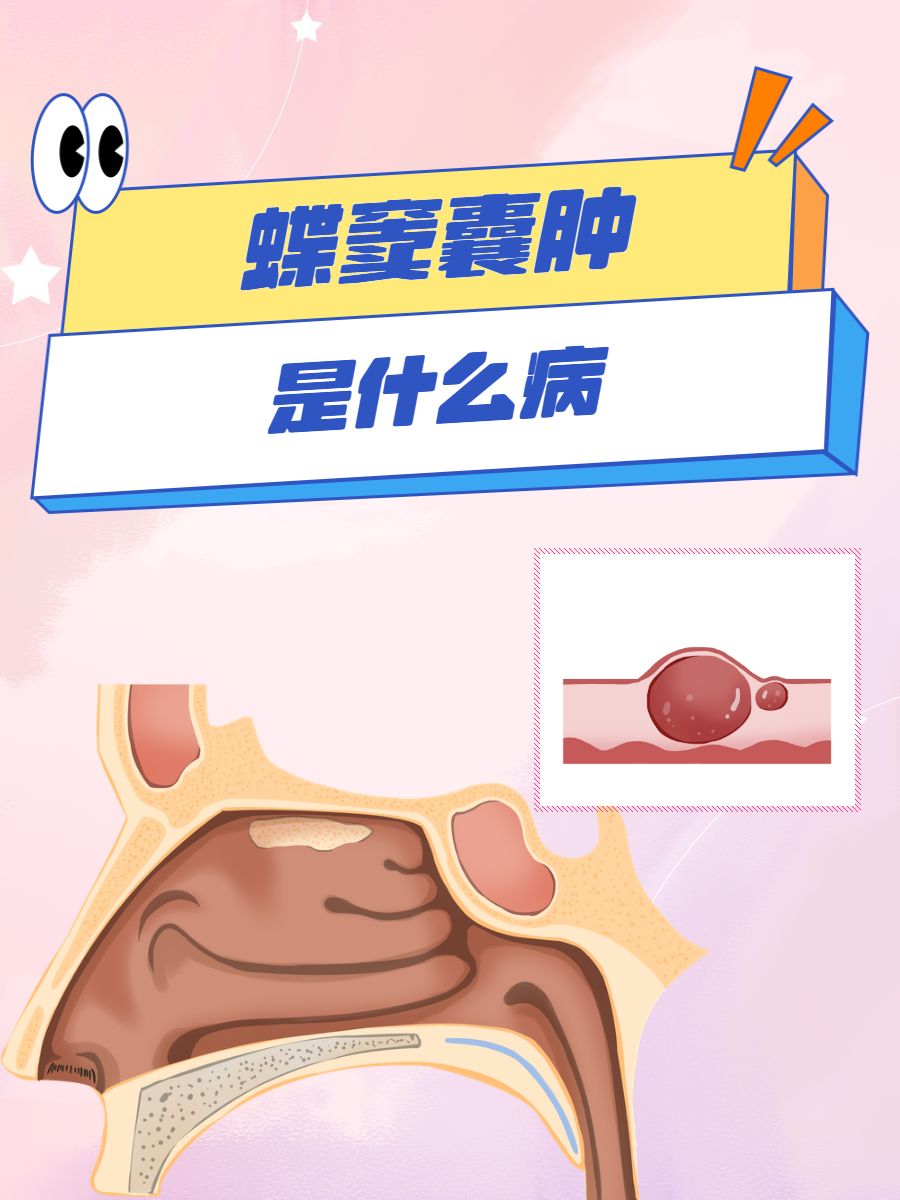 蝶窦囊肿是什么病?