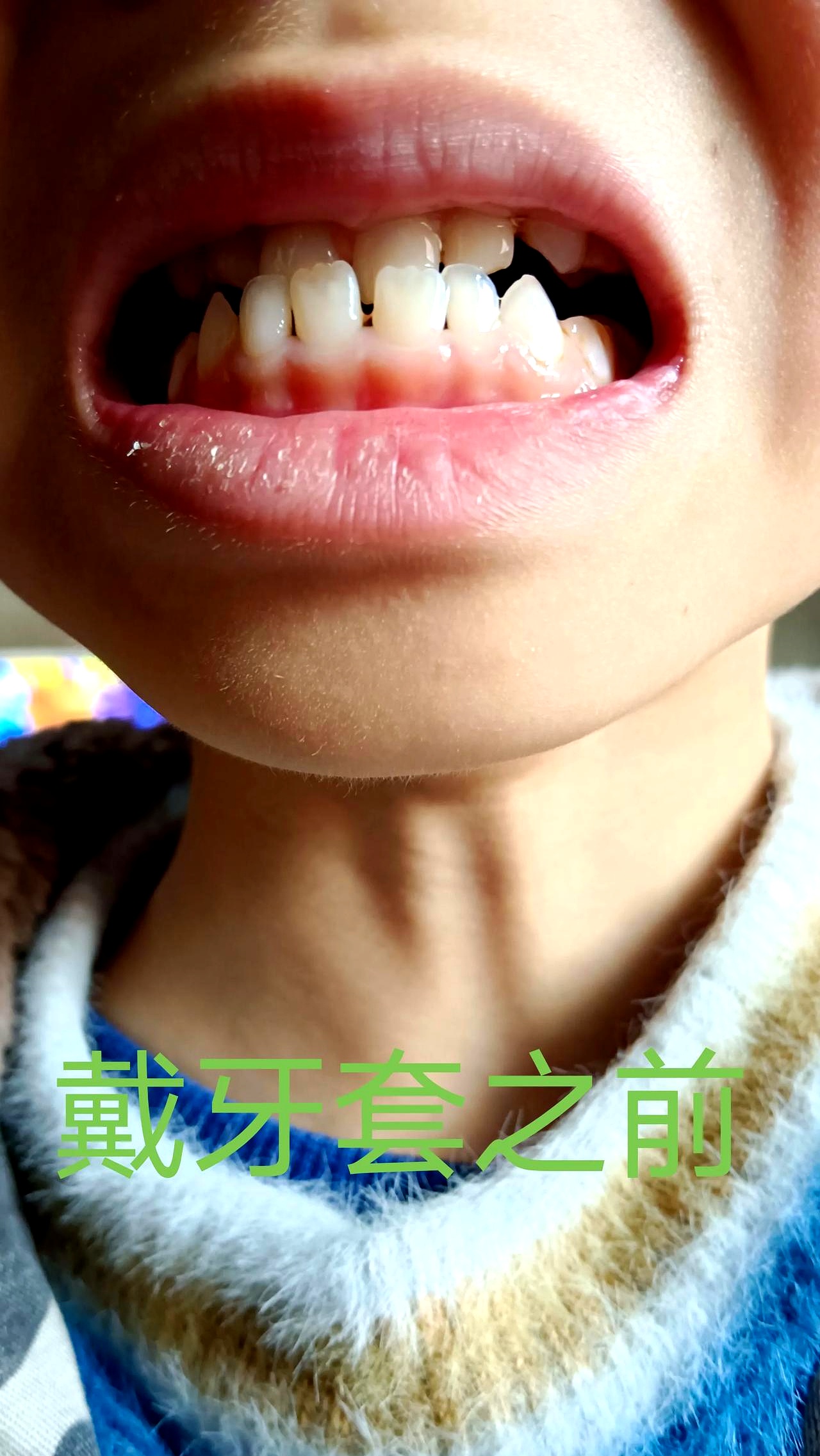 我不知道其他孩子戴了 昨天晚上,我和老婆因为孩子牙齿是"地包天"的事