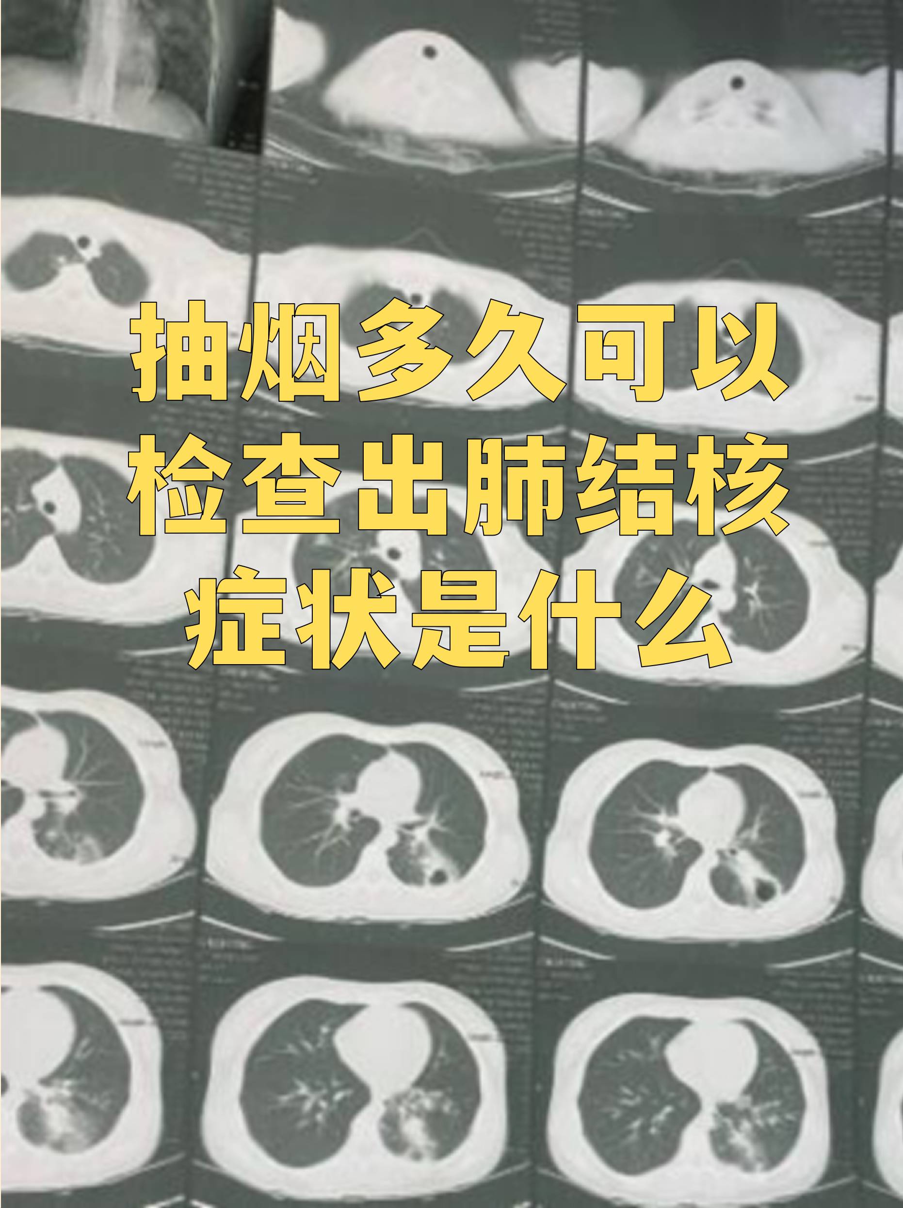 吸烟会损伤肺部防御功能增加感染风险而结核菌潜伏期长短不一从数