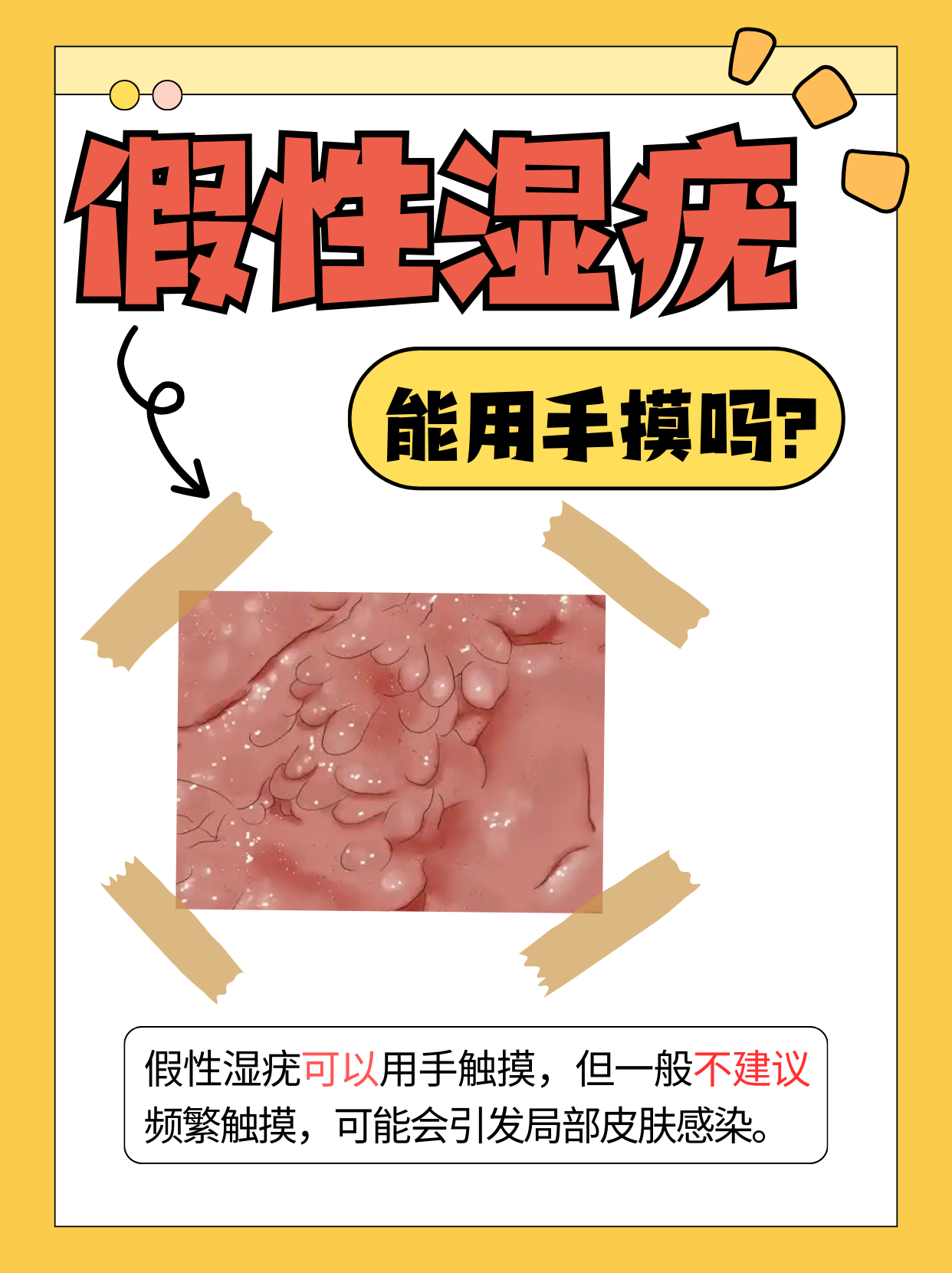 是一种常见于女性阴部的良性病变,通常表现为小丘疹或绒毛状突起,与