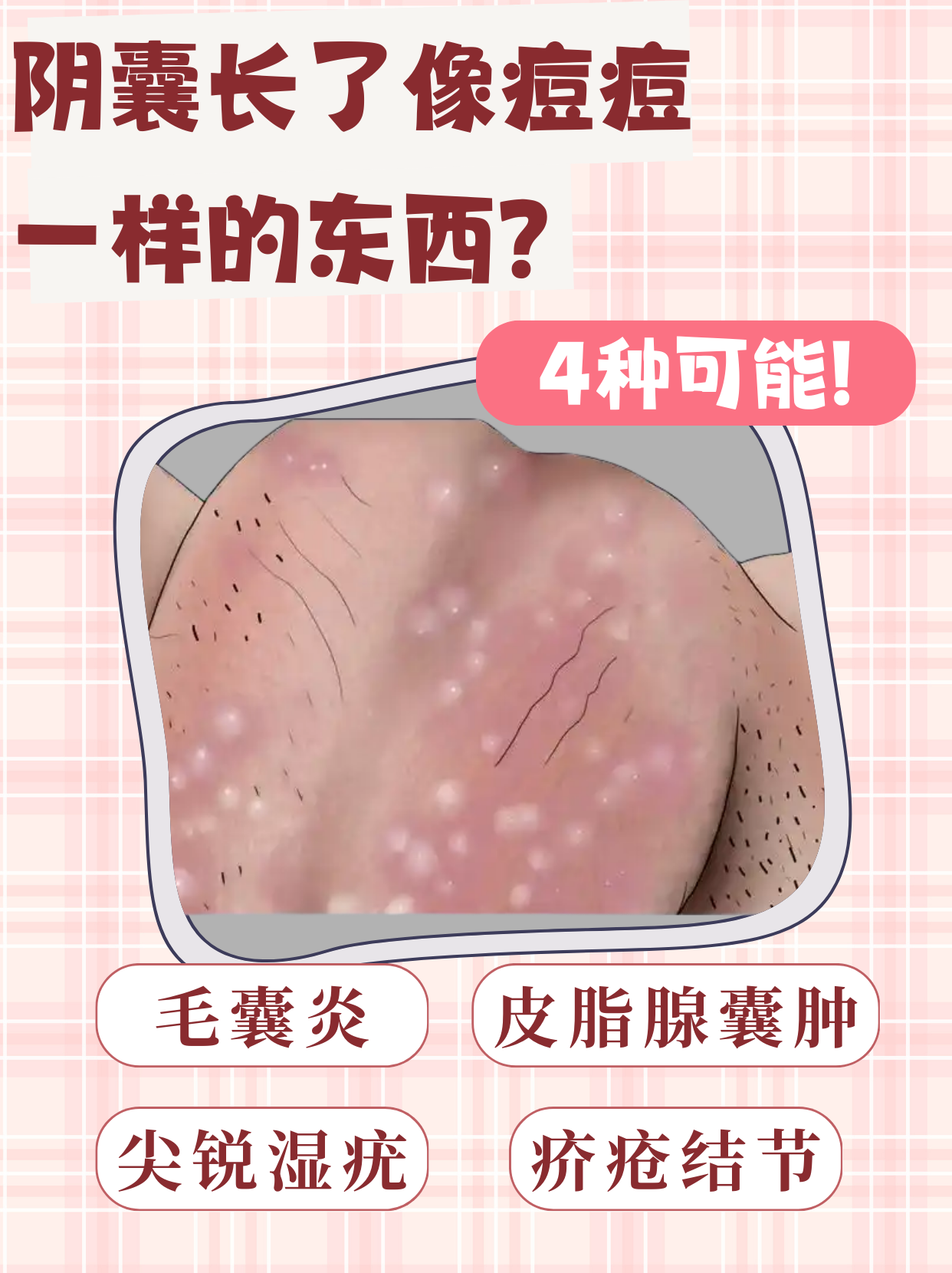 阴囊的皮肤结构较为特殊,分布着大量的毛囊,皮脂腺等