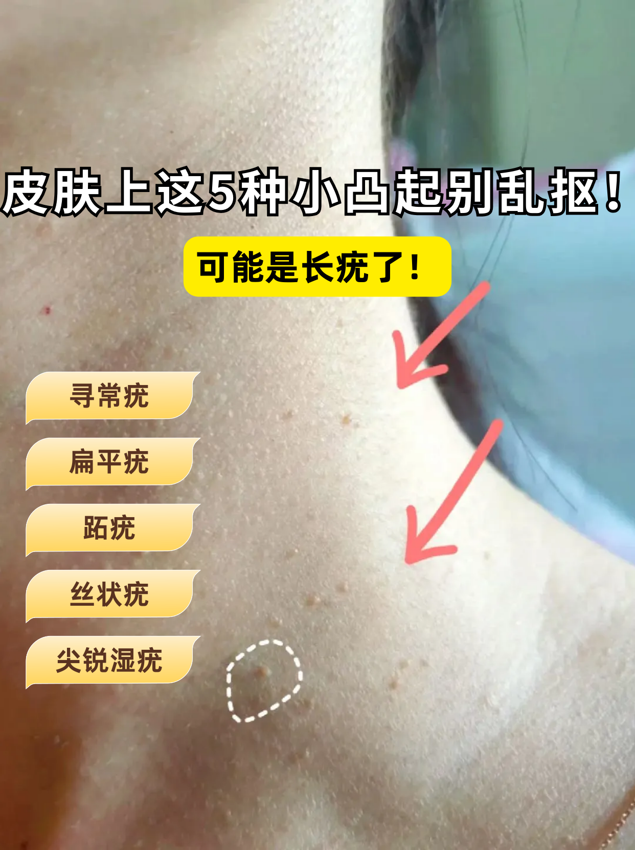 皮肤上这5种小凸起可能是疣!
