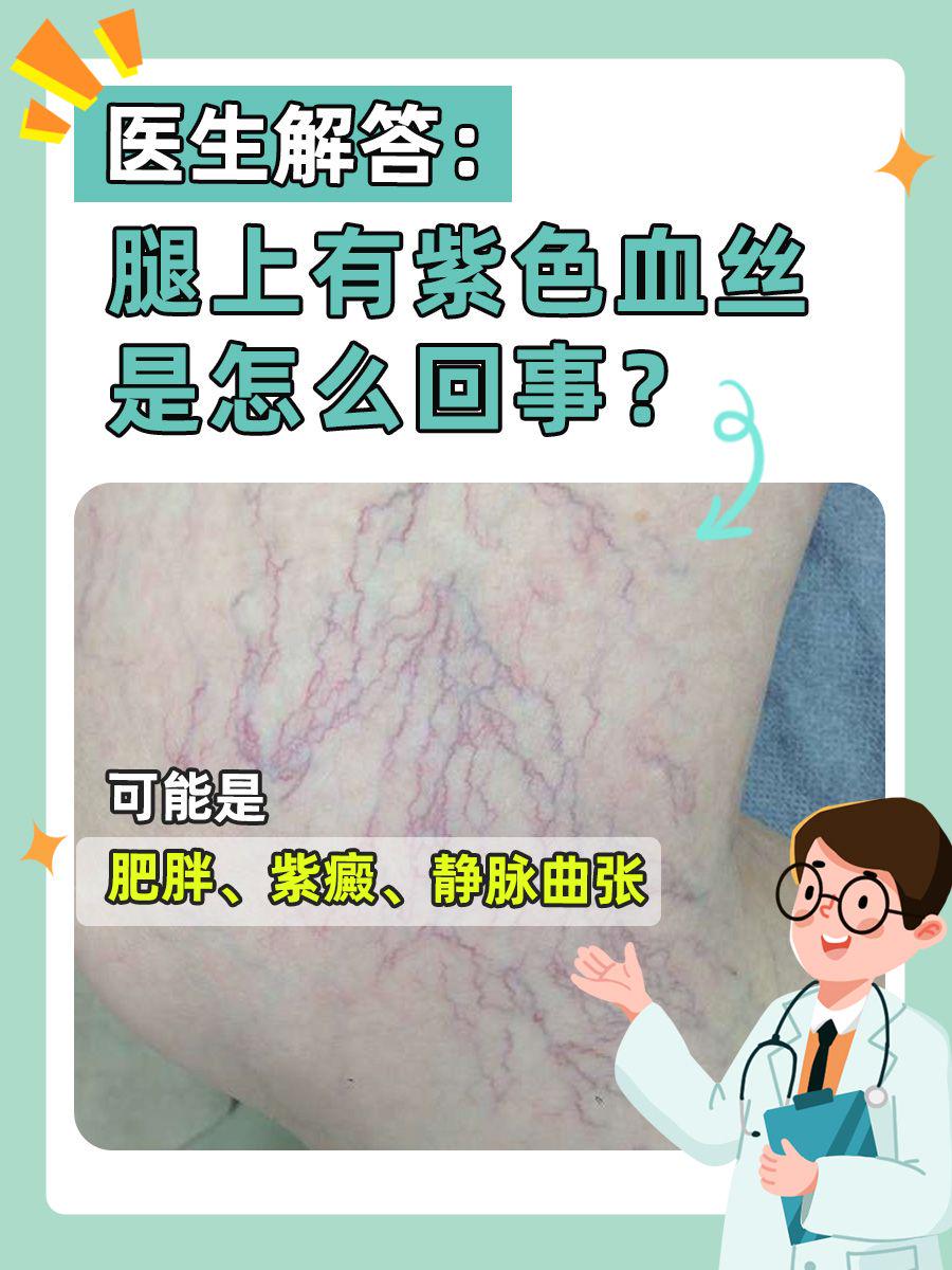 医生解答:腿上有紫色血丝是怎么回事?