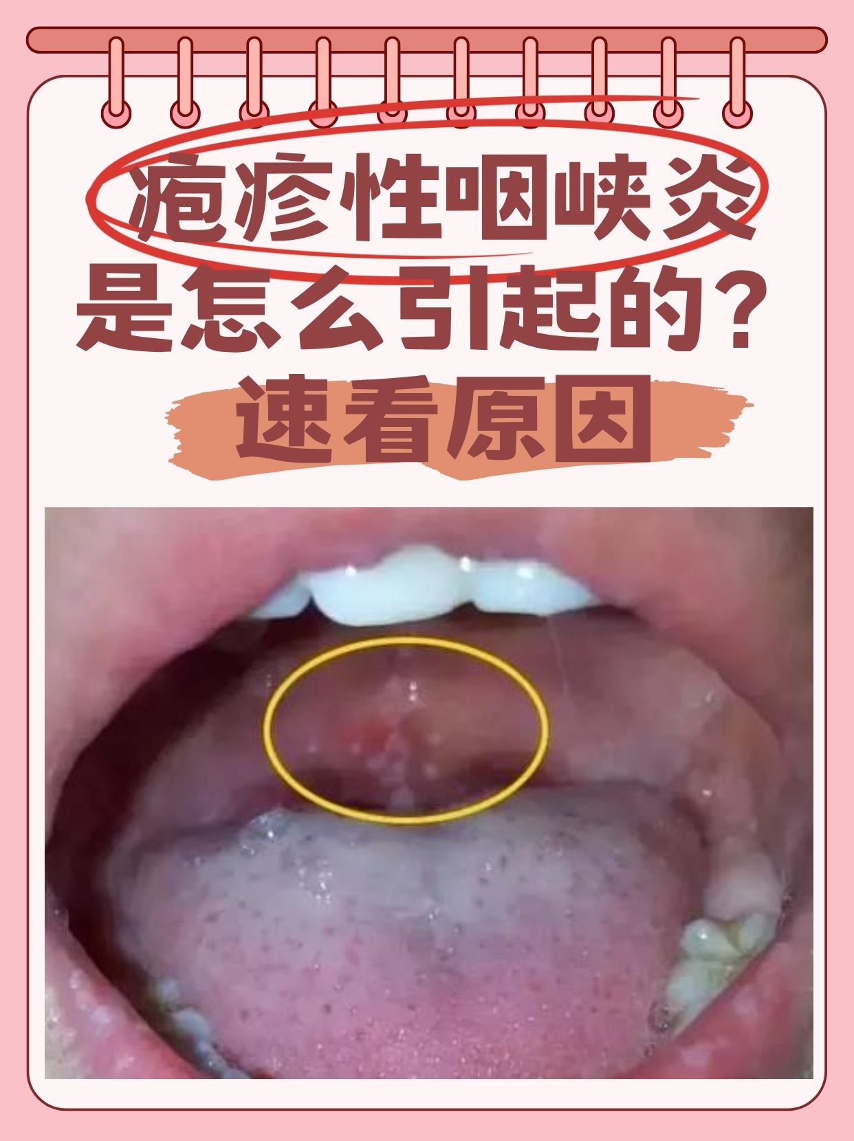 速看原因  疱疹性咽峡炎是一种常见于儿童的急性感染性疾病,以咽喉部