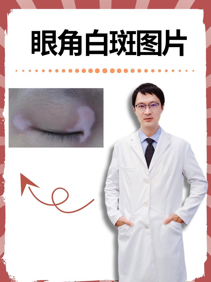眼角白斑图片  眼角白斑的症状主要表现为眼角部位出现白色斑点或斑块