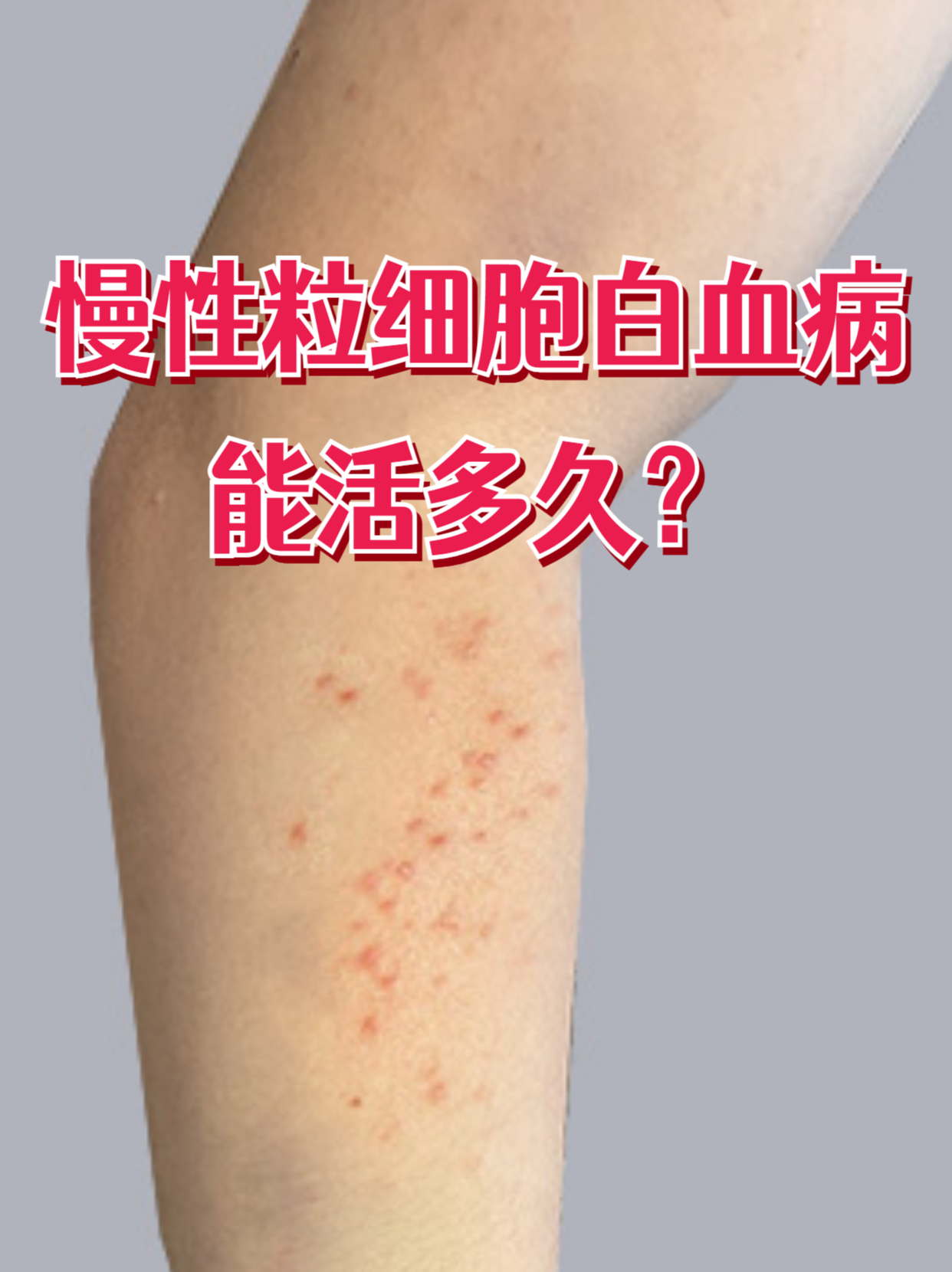 是恶性血液病,但随着治疗进步,规范治疗后