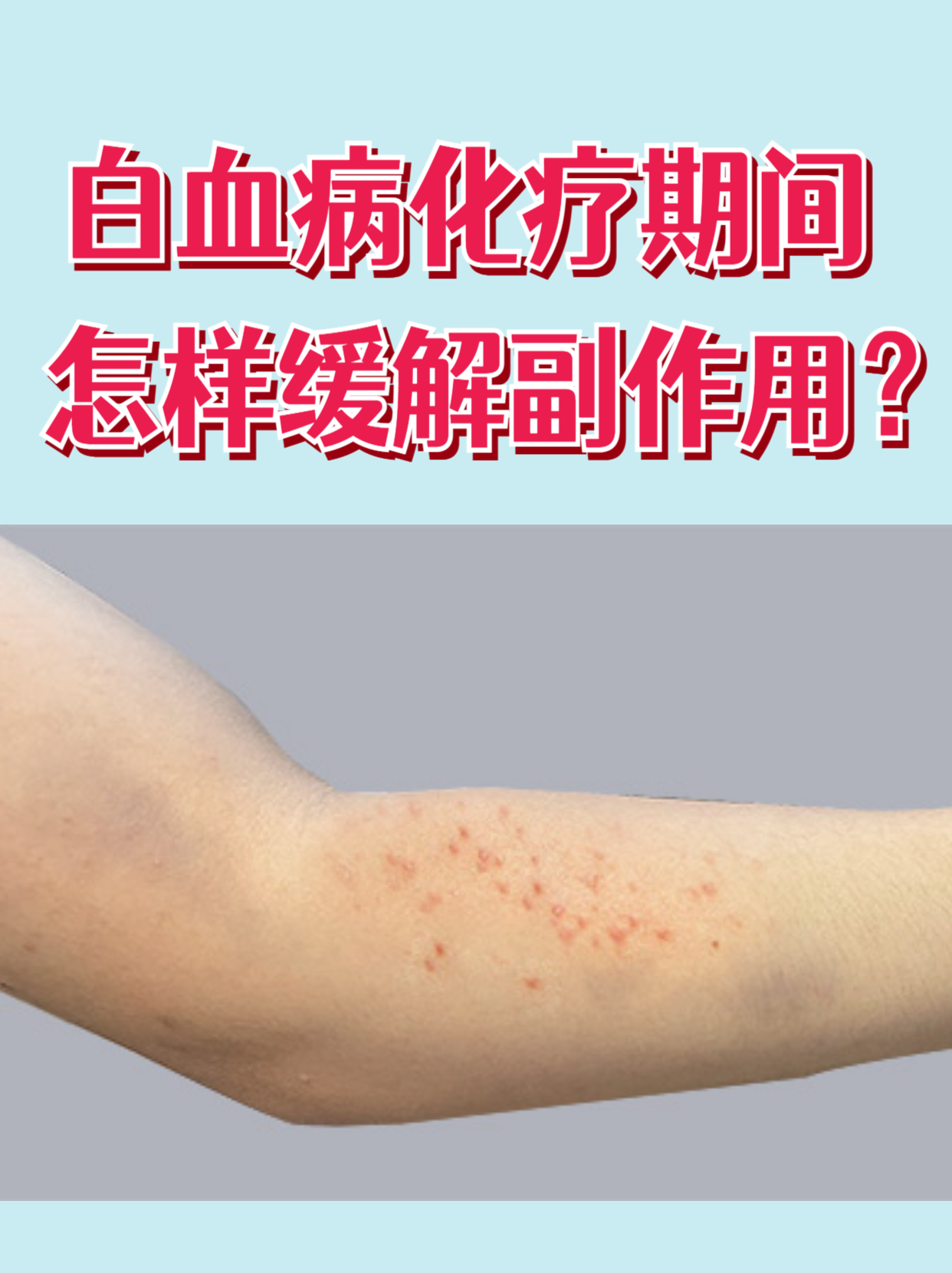 白血病化疗副作用影响生活质量,通过针对性措施可有效缓解,帮助平稳