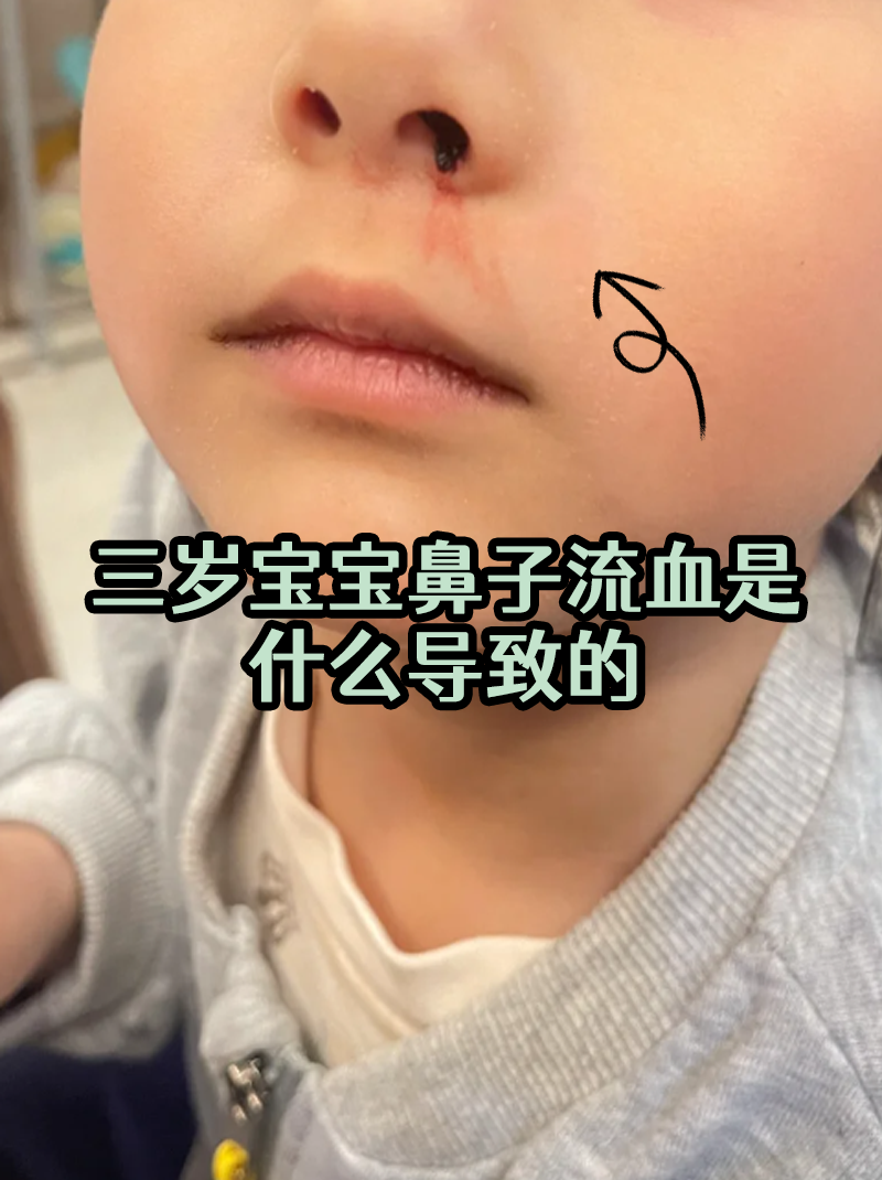 为什么小孩半夜睡着觉流鼻血