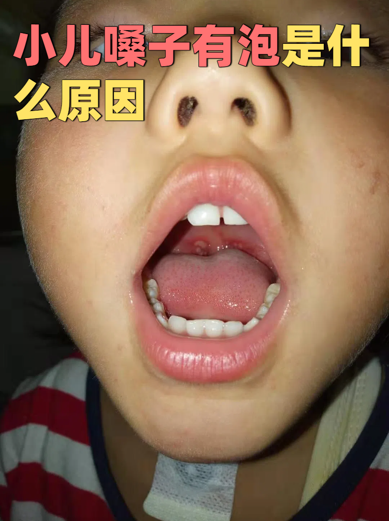 炎喉咙里有泡泡是什么原因腭咽弓滤泡小孩喉咙有泡泡是怎么回事手足口
