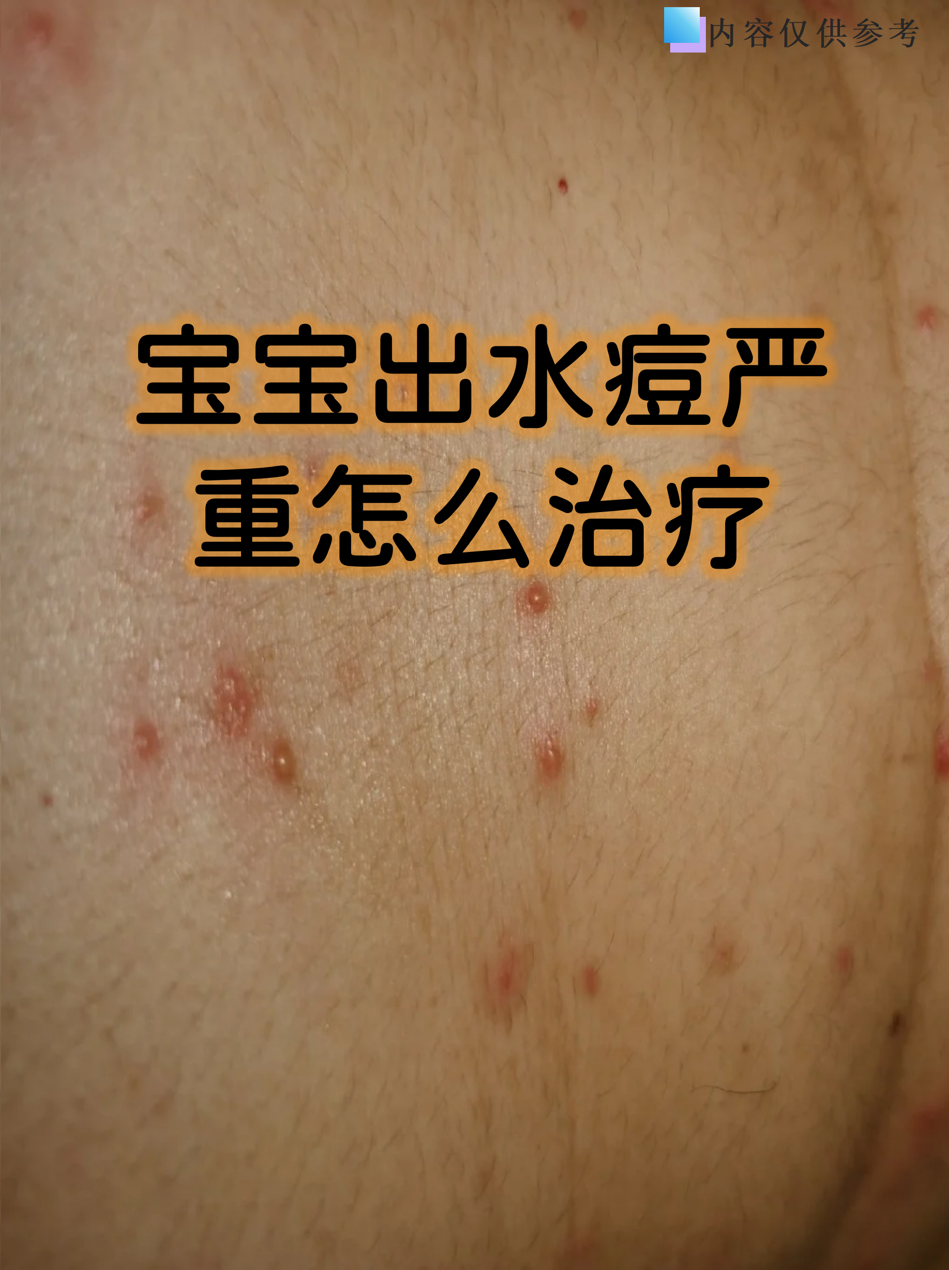 水痘属于自限性疾病,多数患儿1