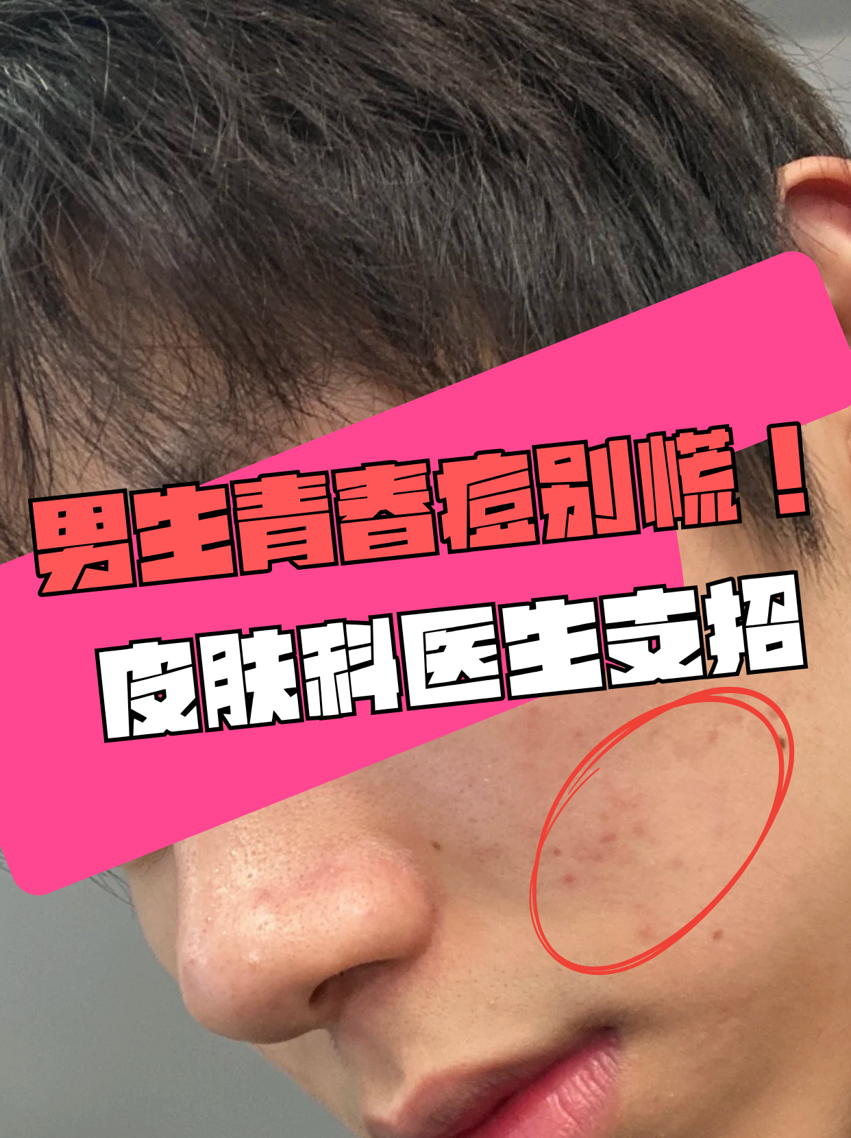 男生为什么会长青春痘