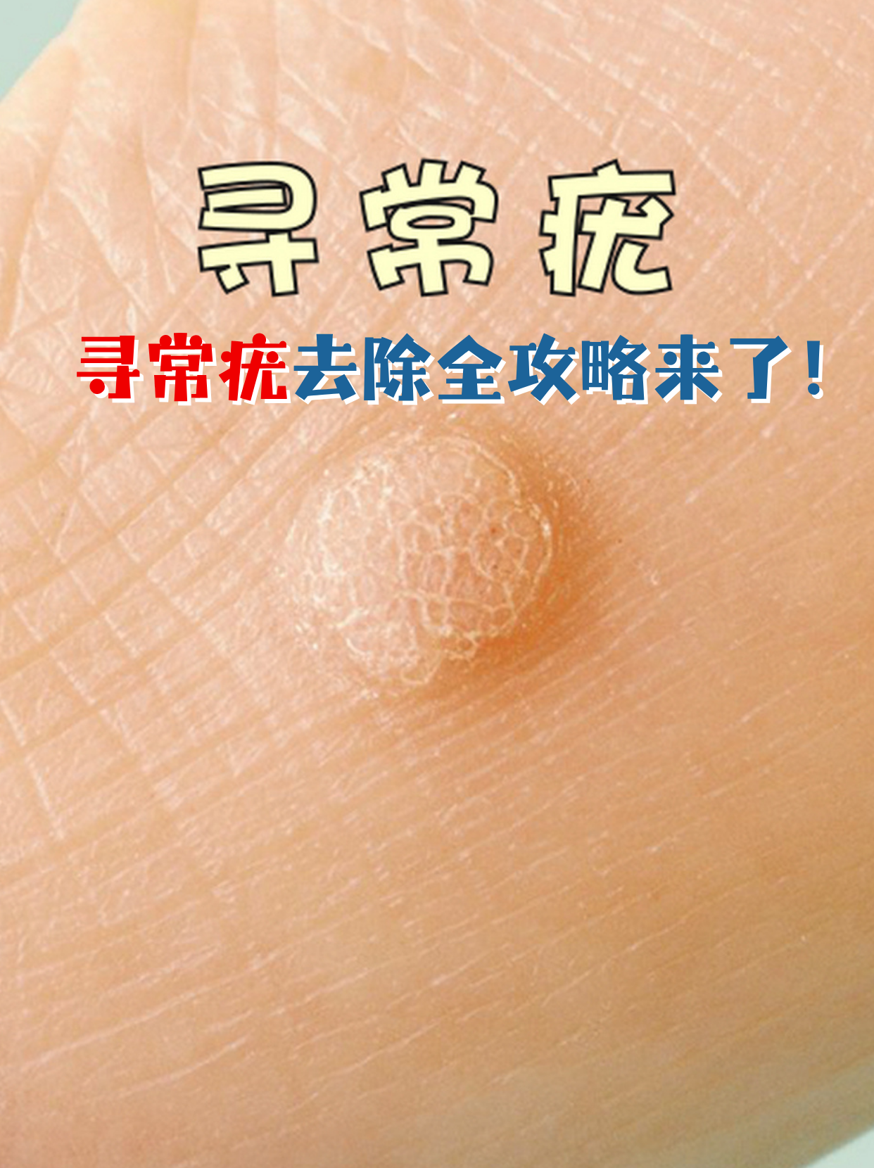 科学去除方法 外用药治疗 物理治疗 手术切除