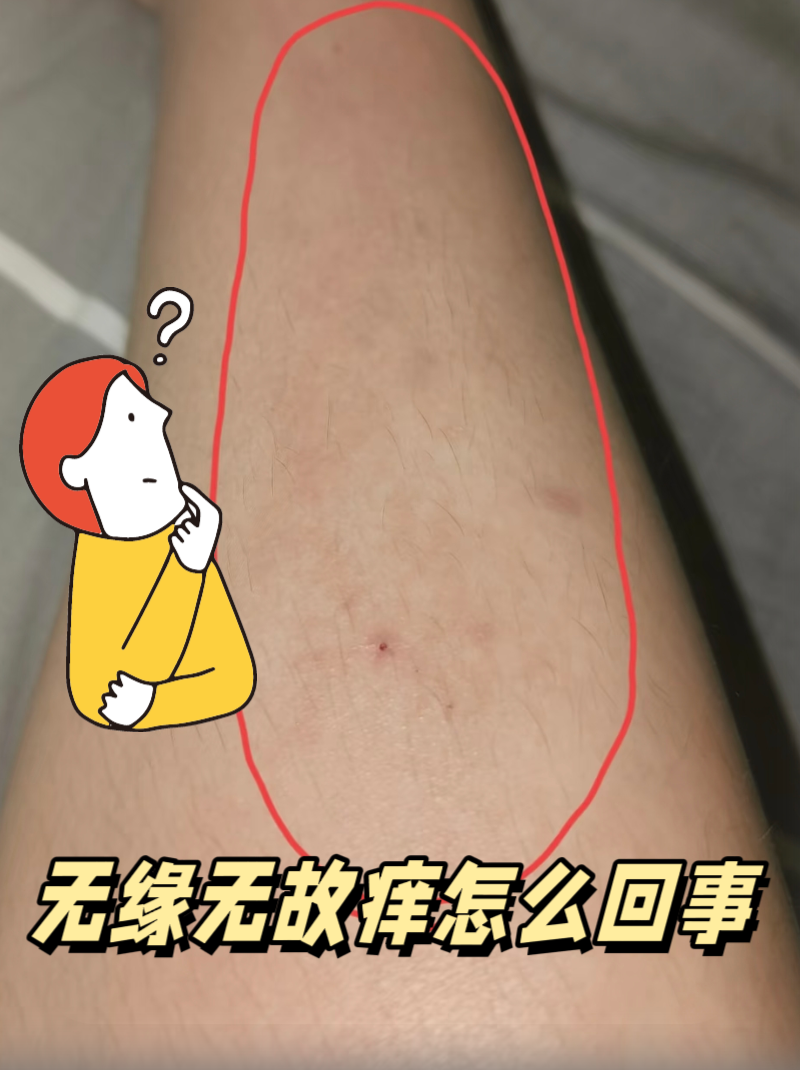 皮肤无故发痒,用手挠过会像蚊子叮过一样,红红一片,主要是胳膊、腿和背上,这是怎么回事?