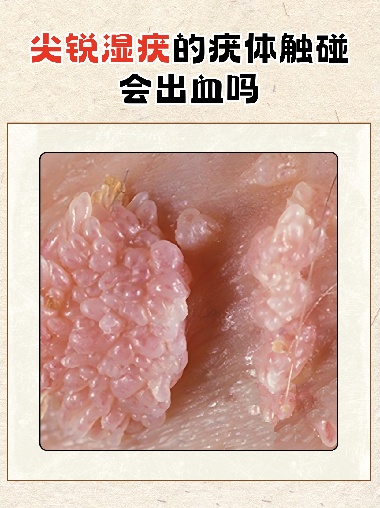 尖锐湿疣的疣体触碰会出血吗