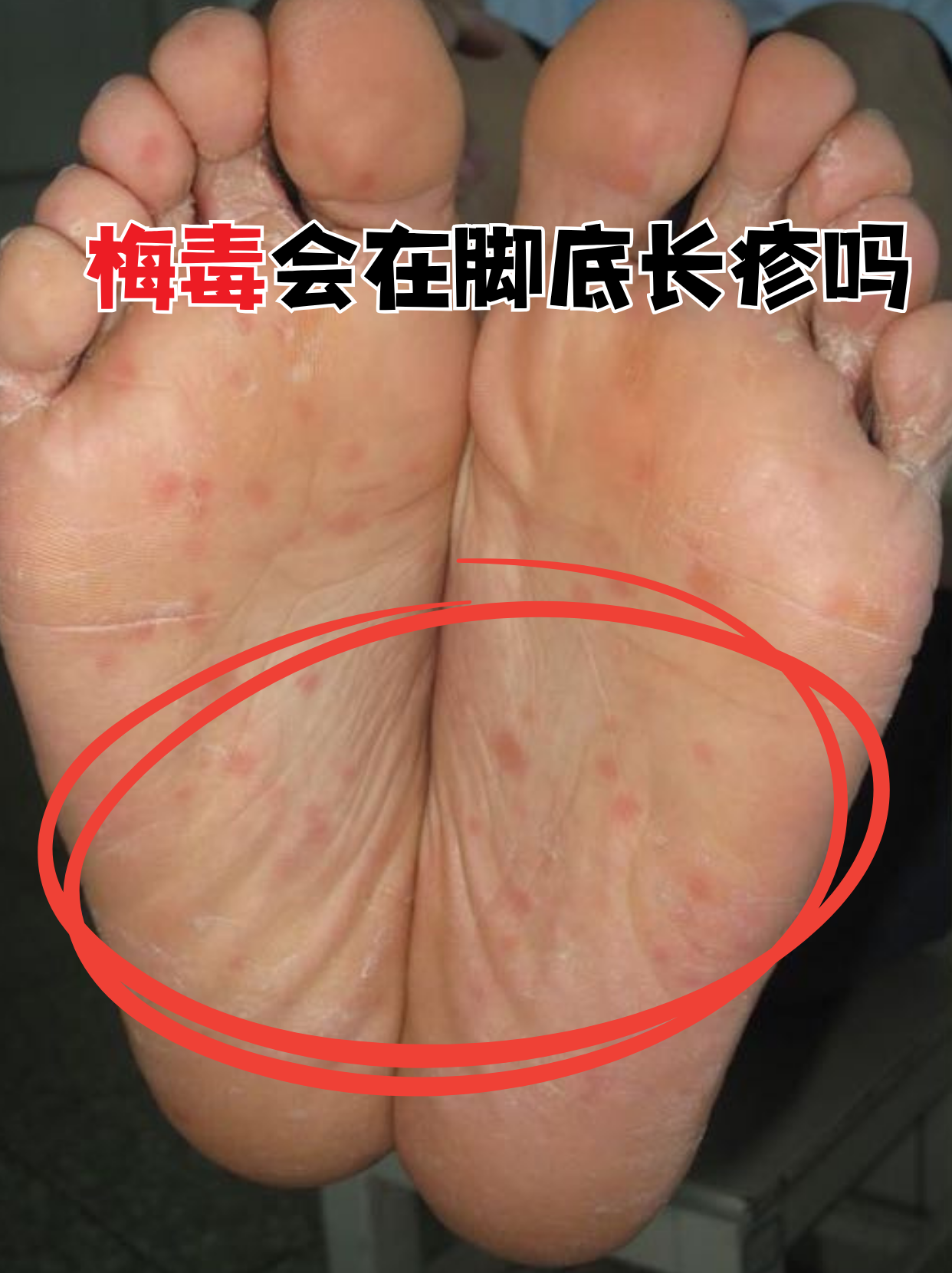 梅毒确实可能引起脚底皮疹,但容易被误认为普通