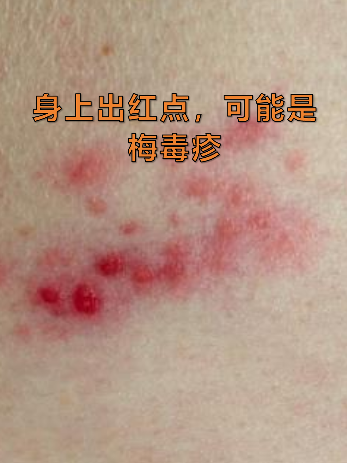 身上出红点,可能是梅毒疹