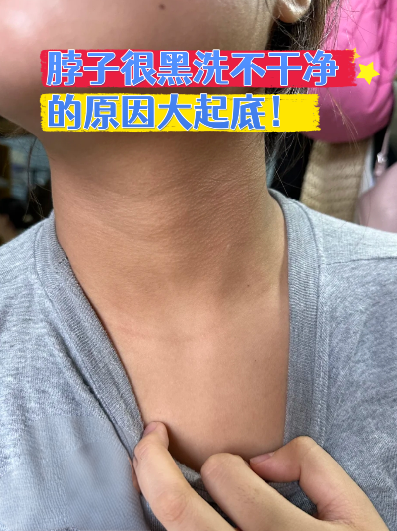 脖子很黑洗不干净的原因大起底!