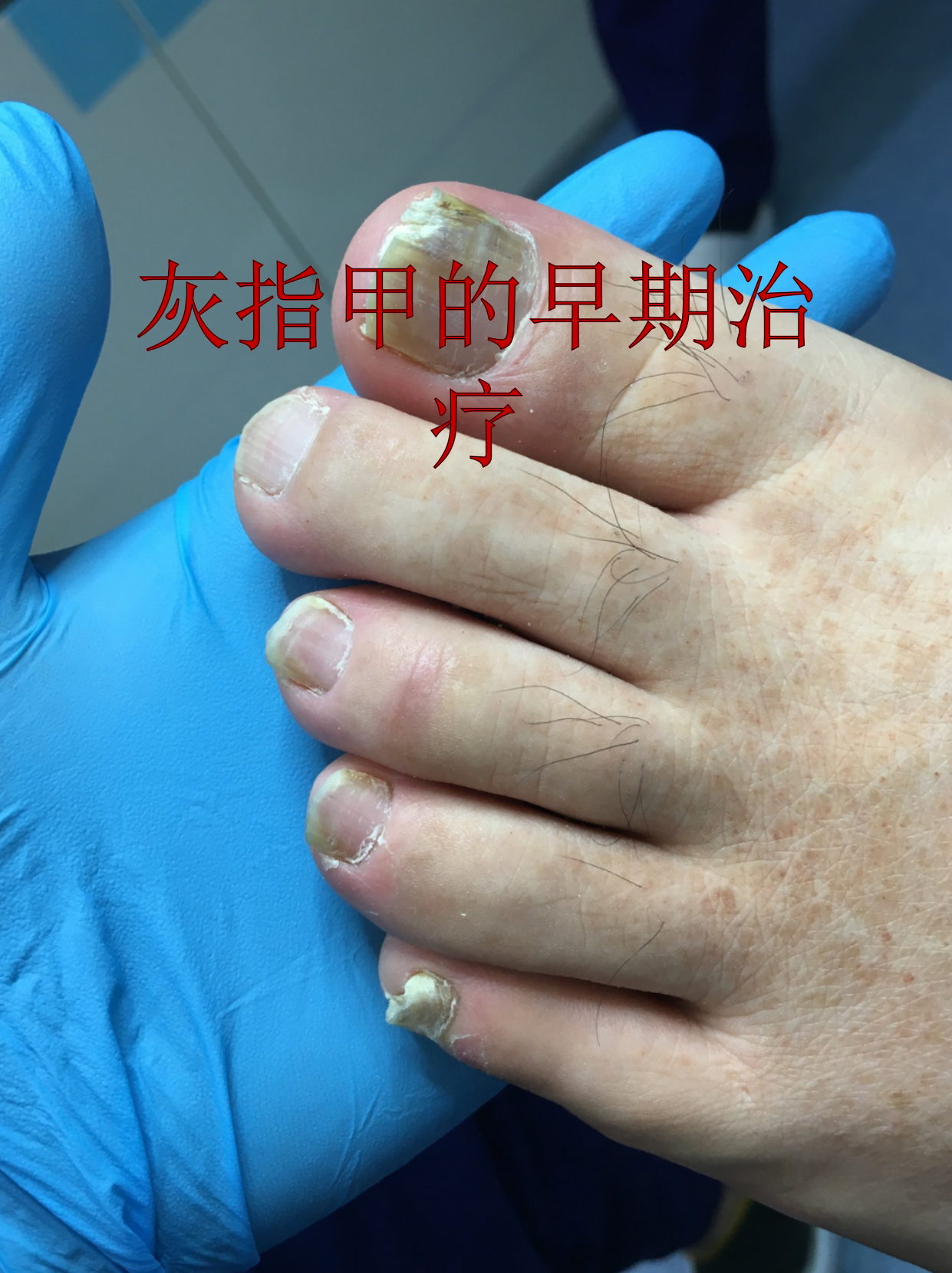 灰指甲的早期治疗其实并不复杂,关键在于及时发现