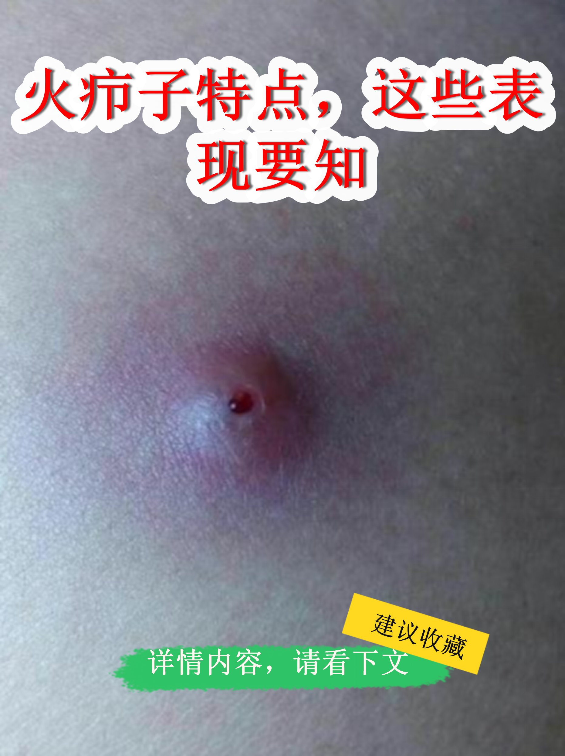 火疖子是一种常见的皮肤感染,初期像红肿的痘痘,但处理