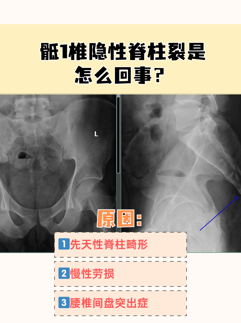 腰椎骶1图片