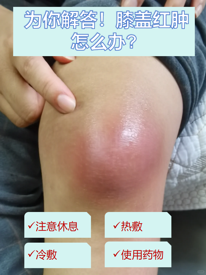 膝盖红肿膝盖肿的图片膝盖肿了膝盖红肿图片膝盖积液水肿图片膝盖痛风