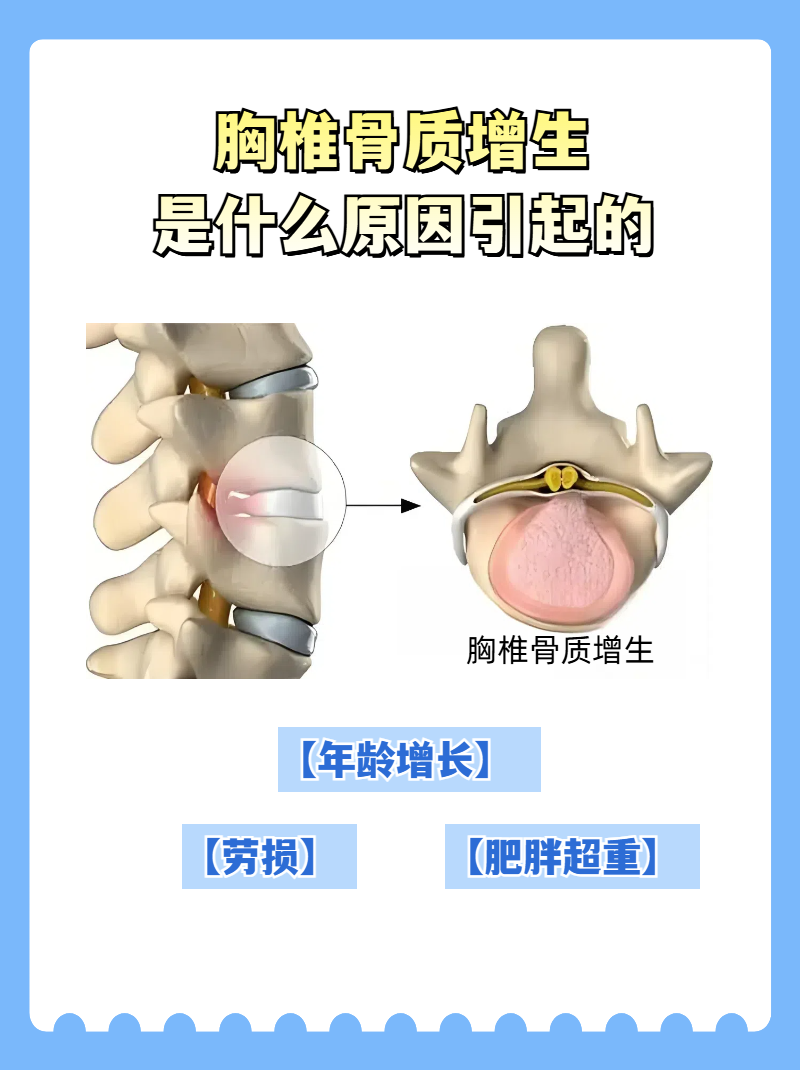 胸椎骨质增生是什么原因引起的  骨质增生严格来说不是一种病