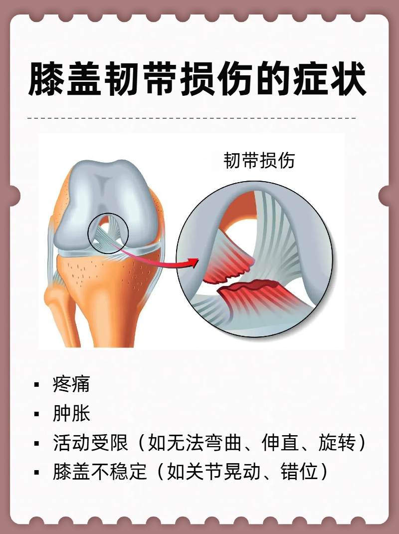 那么膝盖韧带损伤的症状有哪些呢 疼痛:当损伤发生后,患者会感到膝盖