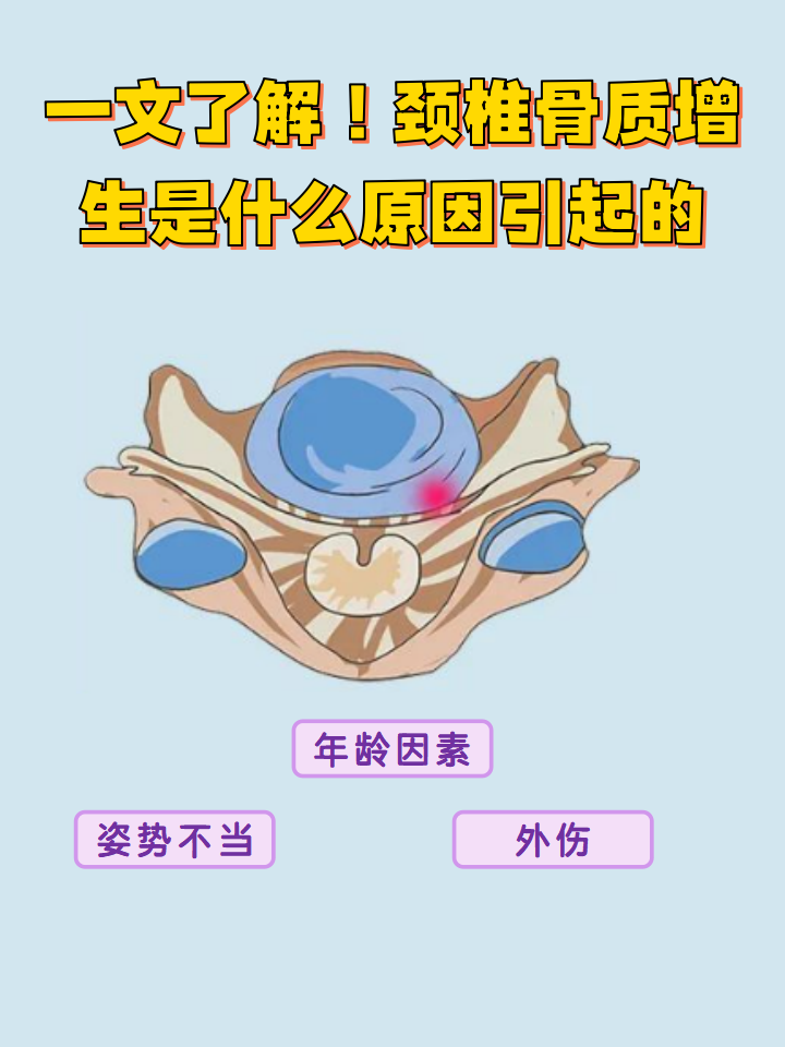 颈椎骨质增生是什么原因引起的  大家知道颈椎骨质增生吗?