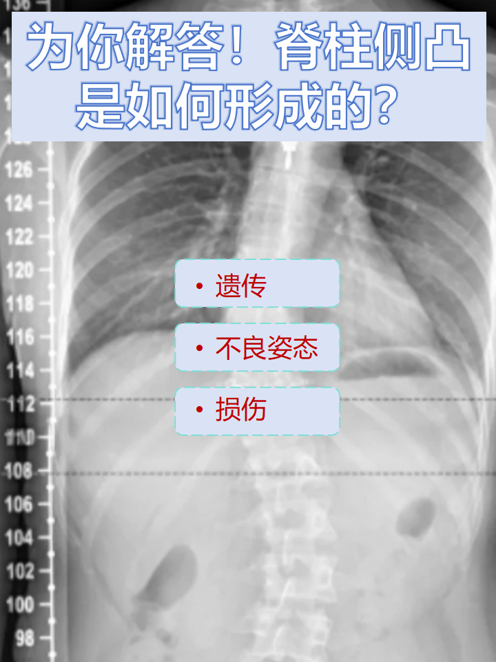 胸椎变形图片