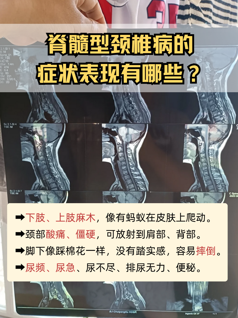 其中就包括了脊髓型颈椎病,那么它的症状表现有哪些呢