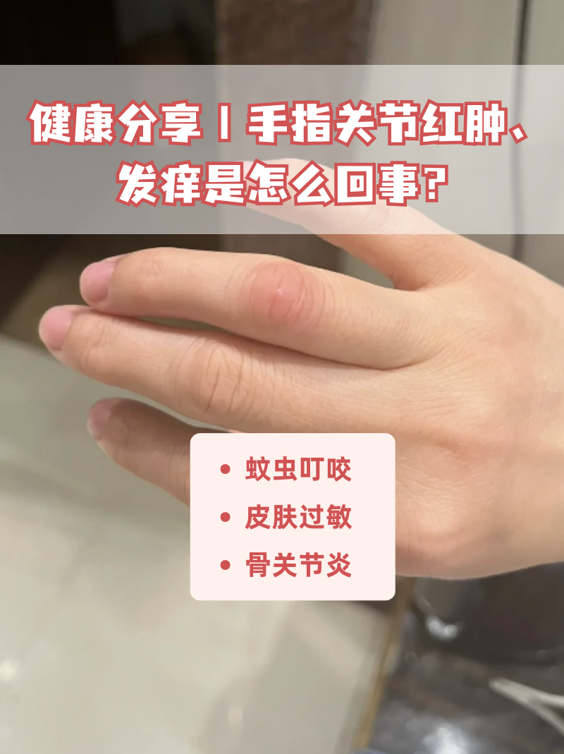 健康分享丨手指关节红肿,发痒是怎么回事?