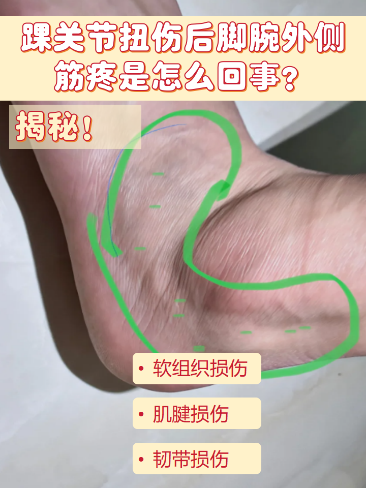 踝关节扭伤后脚腕外侧筋疼是怎么回事?