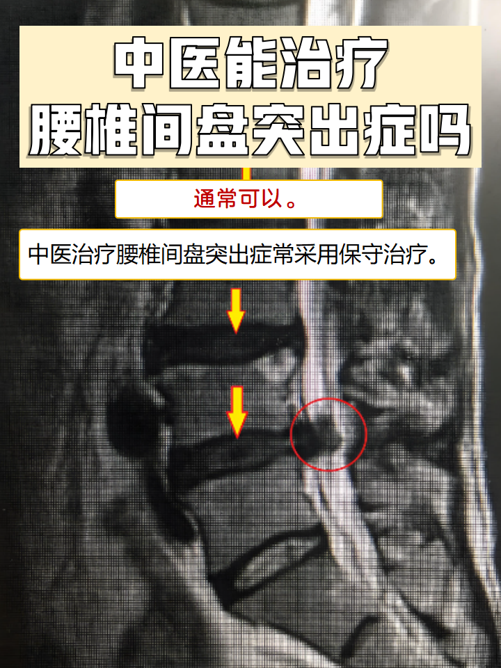 附桂骨痛腰椎间盘突出图片