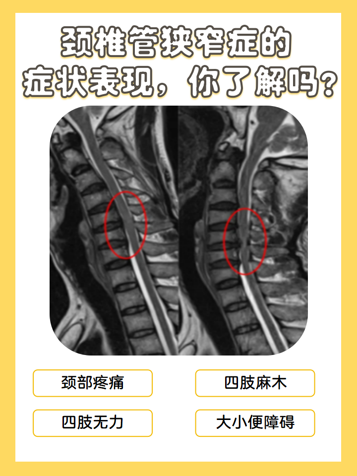 颈椎突出图片 位置图图片