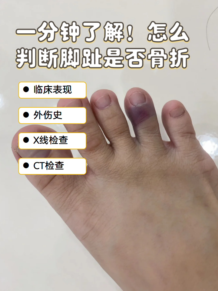 如果怀疑脚趾骨折了,一般可以通过以下方法进行判断: 临床表现,外伤史