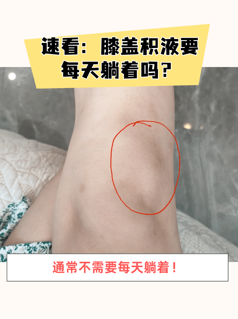 膝盖积液是指膝盖内积聚了过多的液体,导致膝盖肿胀和疼痛