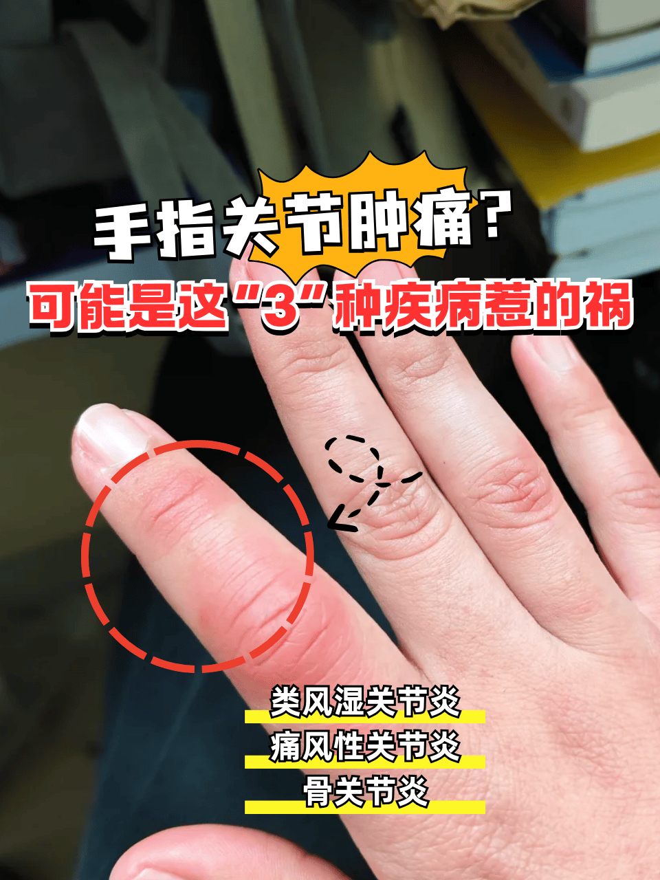 明明没有干什么重活,但是手指关节却出现肿痛的现象,有时候可能会反