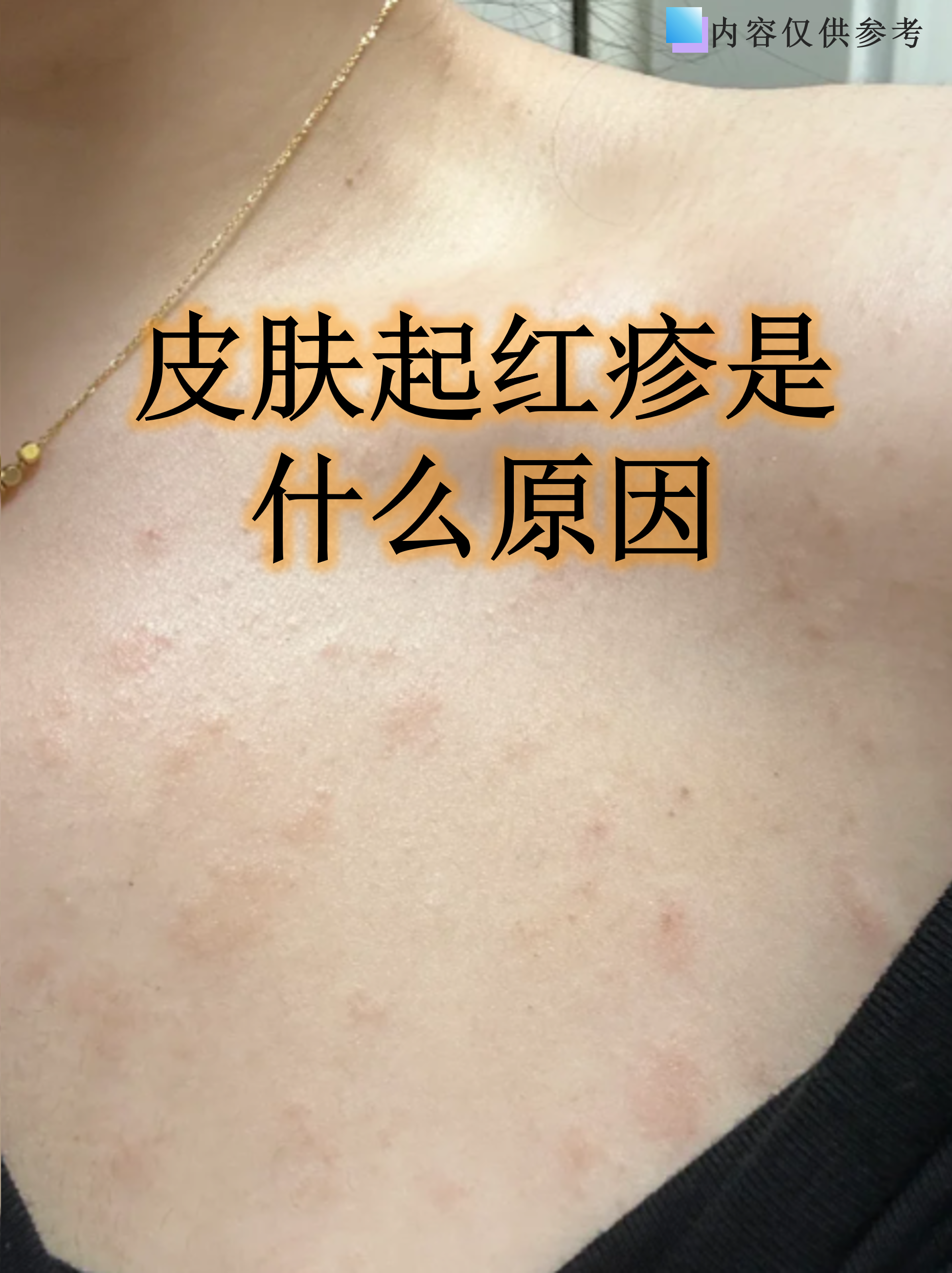 皮肤起红疹可能是身体在向你发出信号,常见于过敏,感染或接触刺激物
