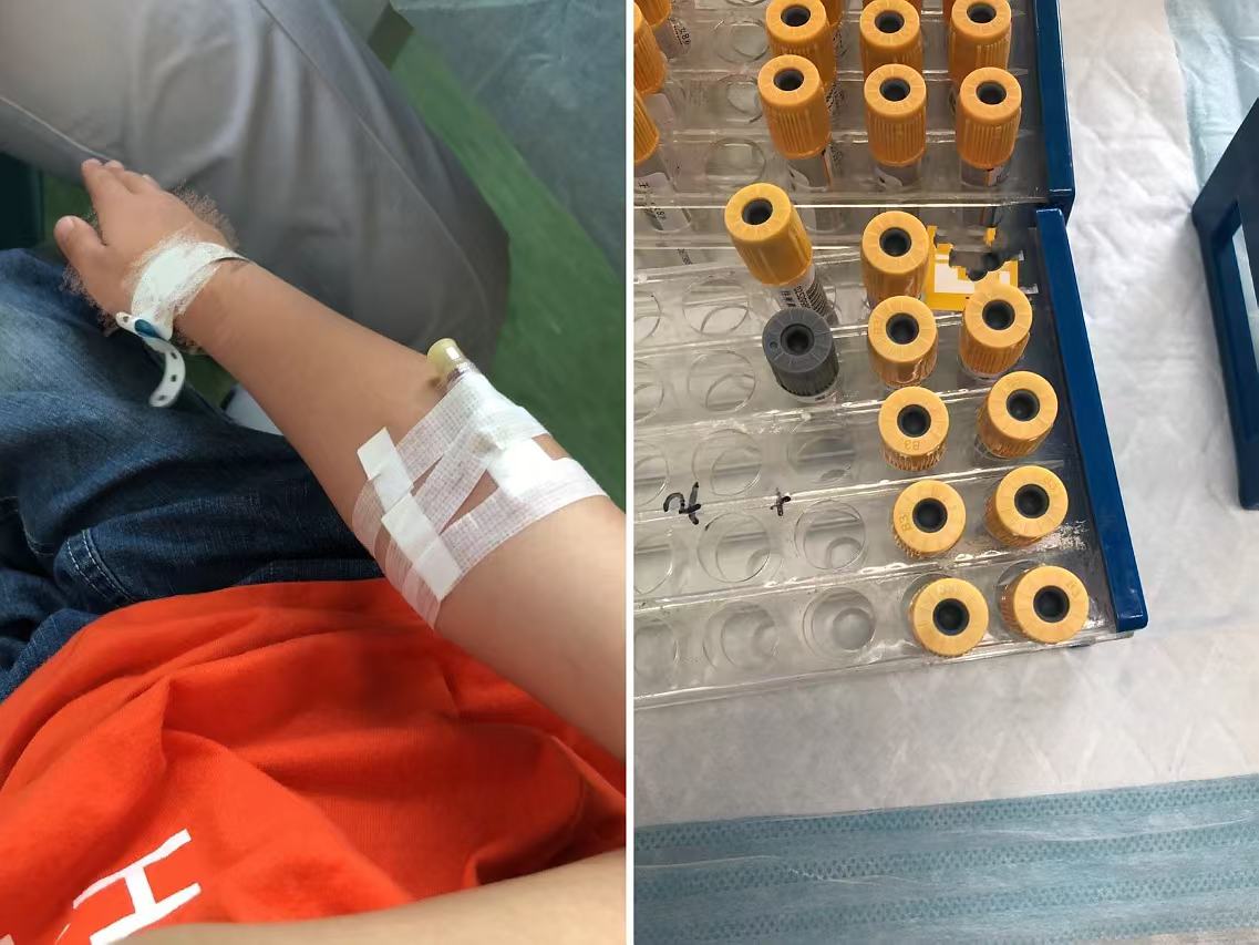  儿童包茎注射儿童手部套管针正确缠弹力绷带暴露穿刺点的照片小孩打