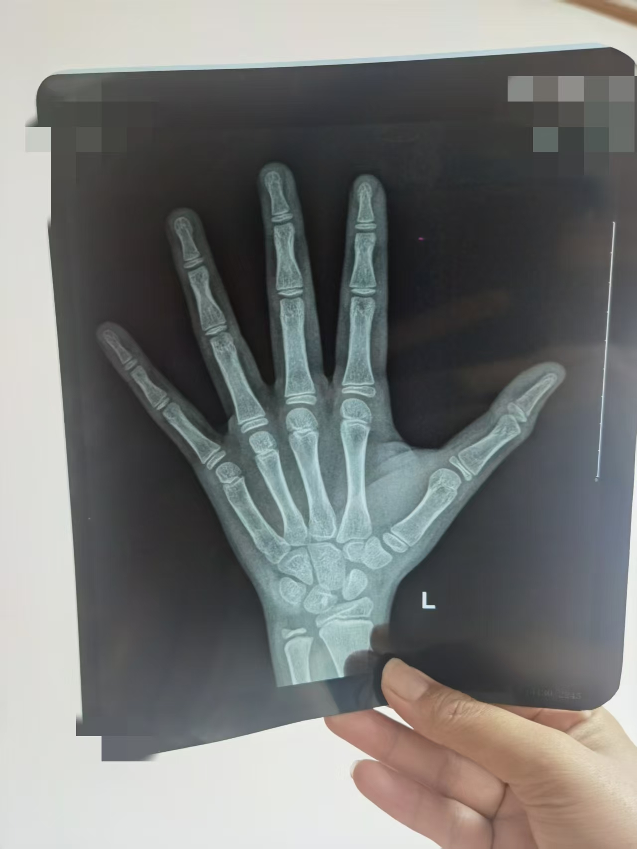 最近后台有很多家长让我帮看骨龄片的,今天我就专门抽出时间,帮大家