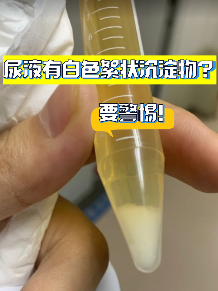 尿液有白色絮状沉淀物?要警惕!
