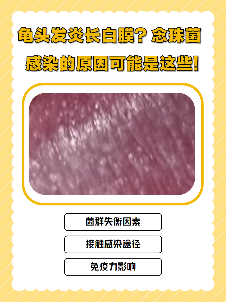 破坏念珠菌性龟头炎念珠菌感染男性白色念珠菌感染图片念珠菌性包皮炎