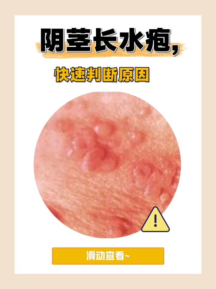 水疱出现的原因可能是以下几个: 疱疹病毒感染 过敏反应所致 摩擦