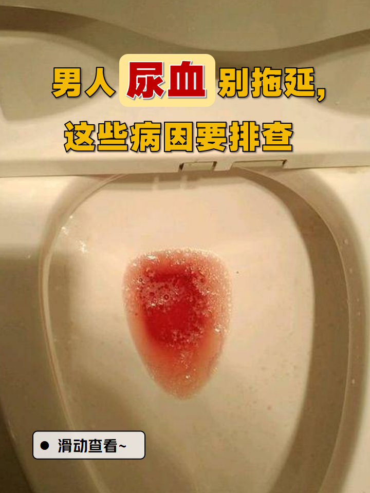 尿血可不是小事,背后可能藏着多种病因,及时排查,科学应对才是关键