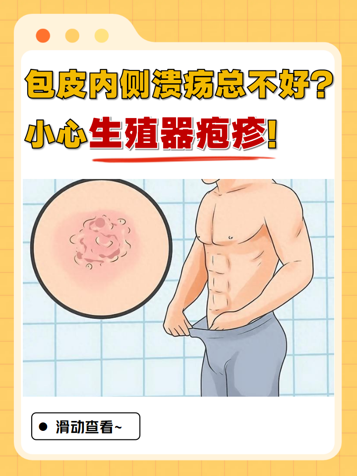 小心生殖器疱疹!