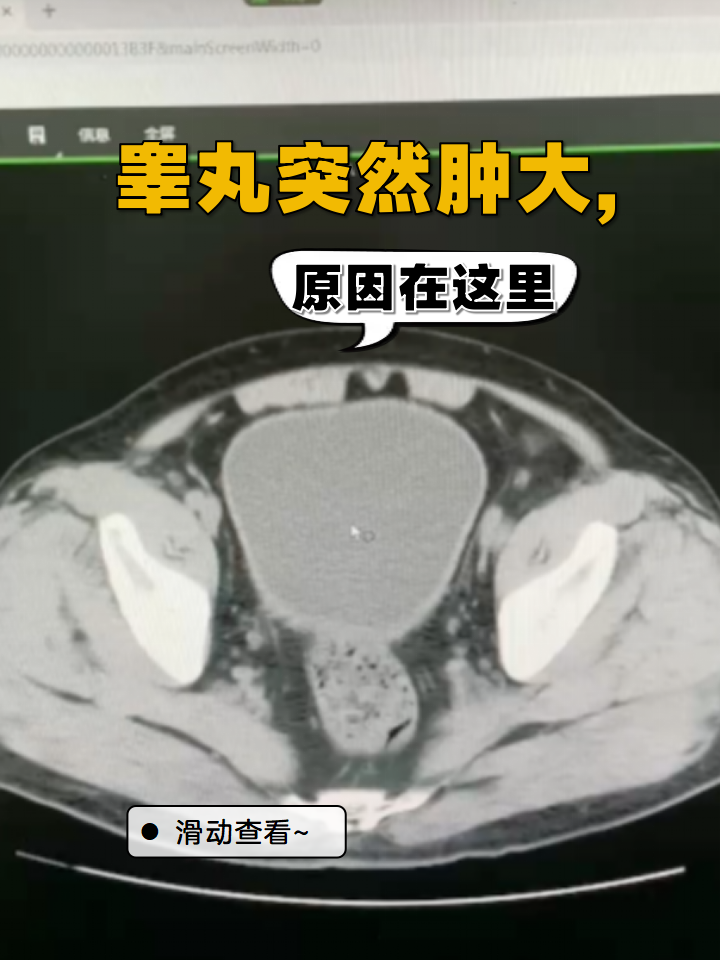 睾丸突然肿大,原因在这里