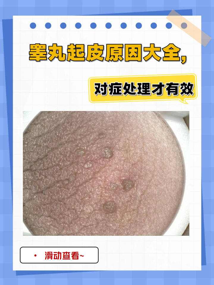 睾丸起皮背后的原因多种多样,可能是以下几个原因: 清洁护理不当 真菌