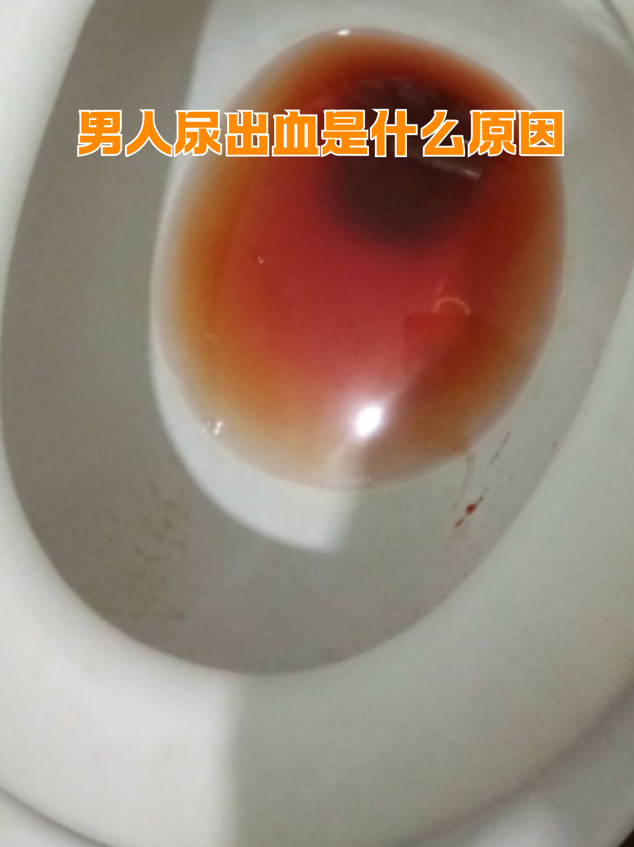 男性出现尿血可不是小事,背后可能藏着泌尿