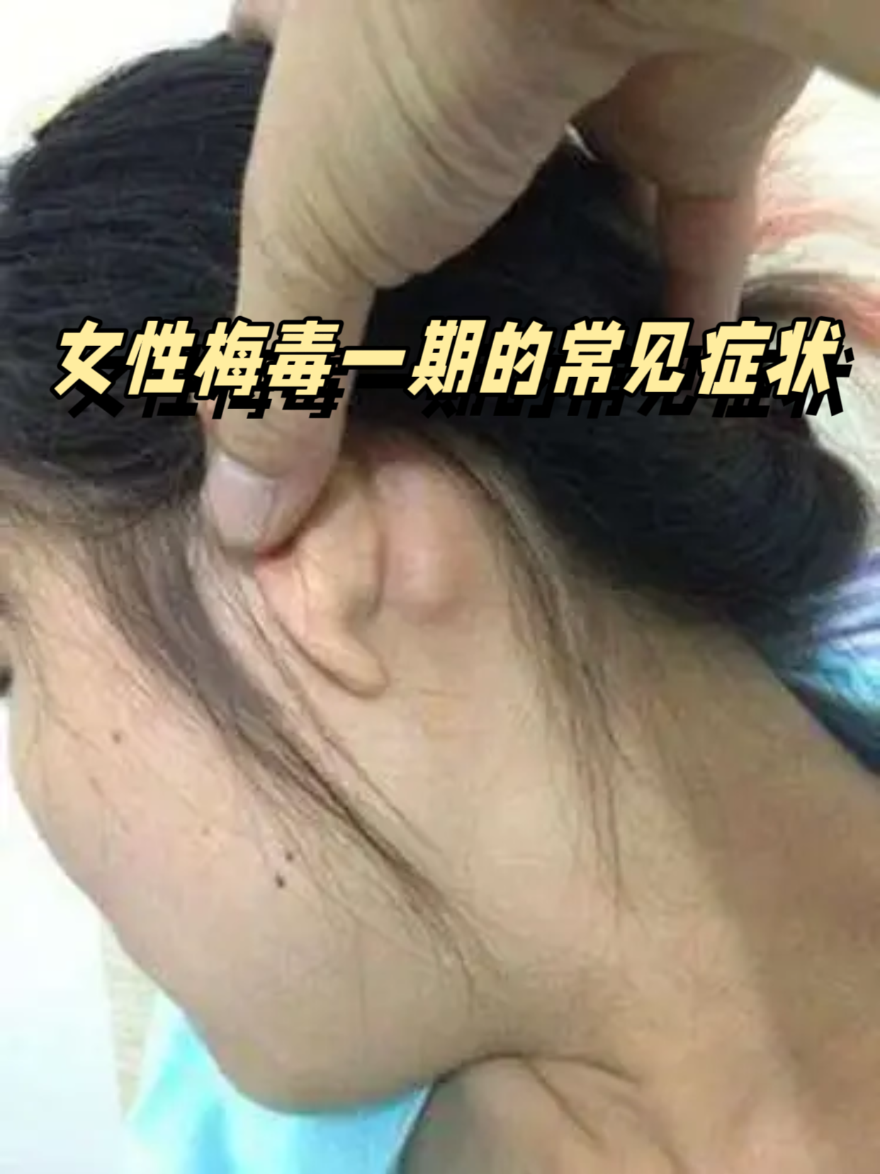 女性梅毒第一期的症状