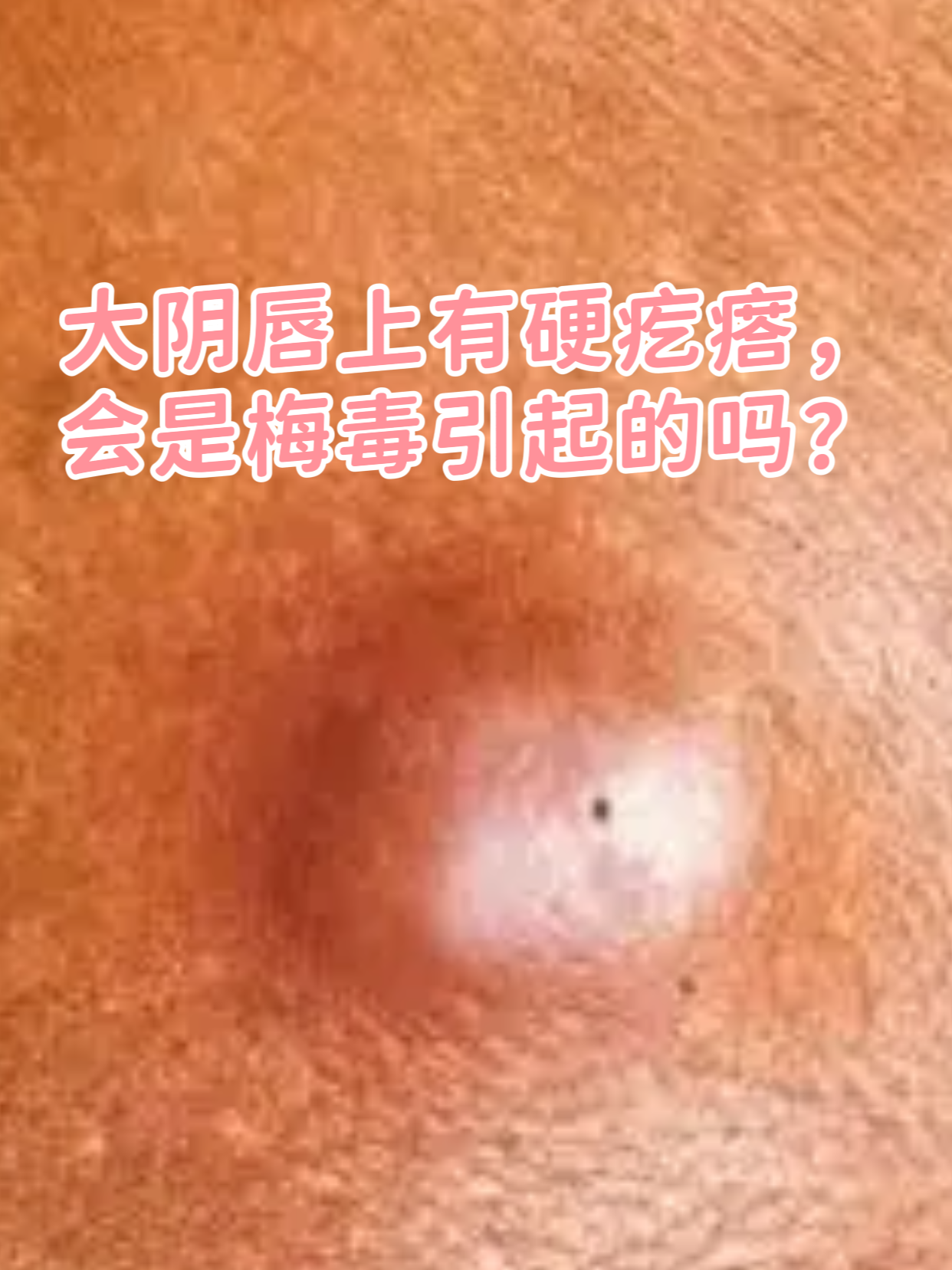 大阴唇上有硬疙瘩,会是梅毒引起的吗?